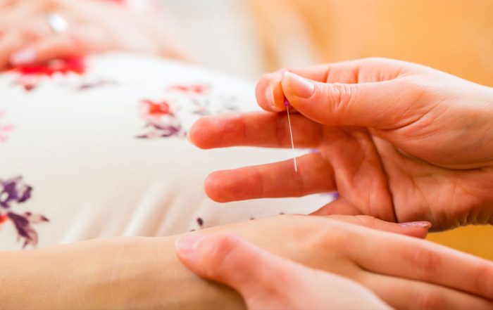 Akupunktura u trudnoći