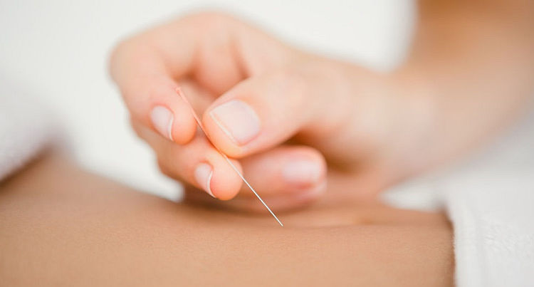 Akupunktura i endometrioza