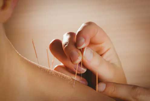 Akupunktura pospješuje uspješnost IVF postupka