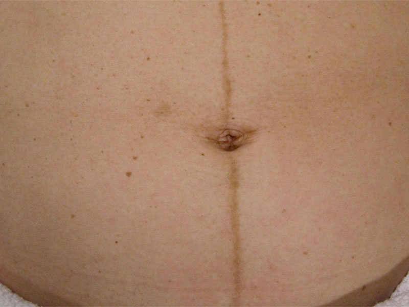 10. tjedan trudnoće - depigmentacija i linea negra