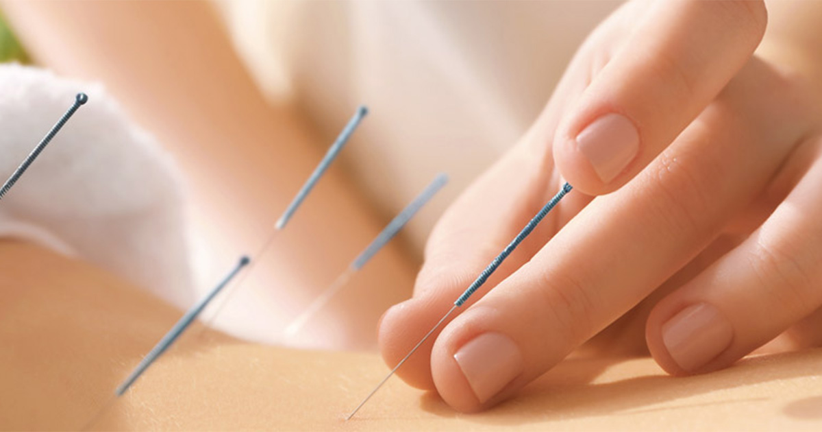 Utjecaj akupunkture na endometriozu