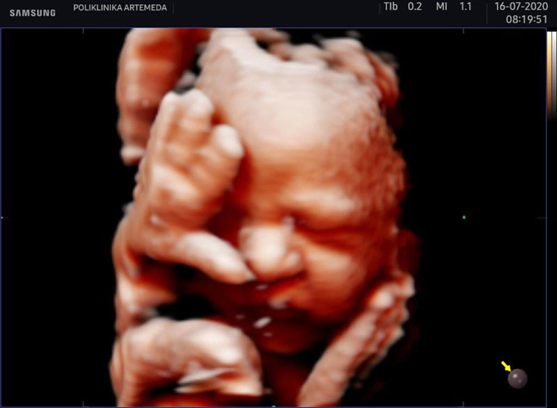 3D ultrazvuk u trudnoći