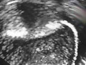 Rentgenska snimka liječenja prohodnosti jajnika