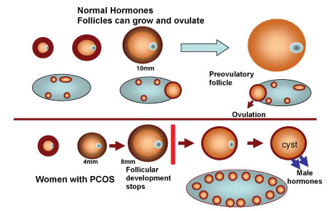 Hormoni i PCOS